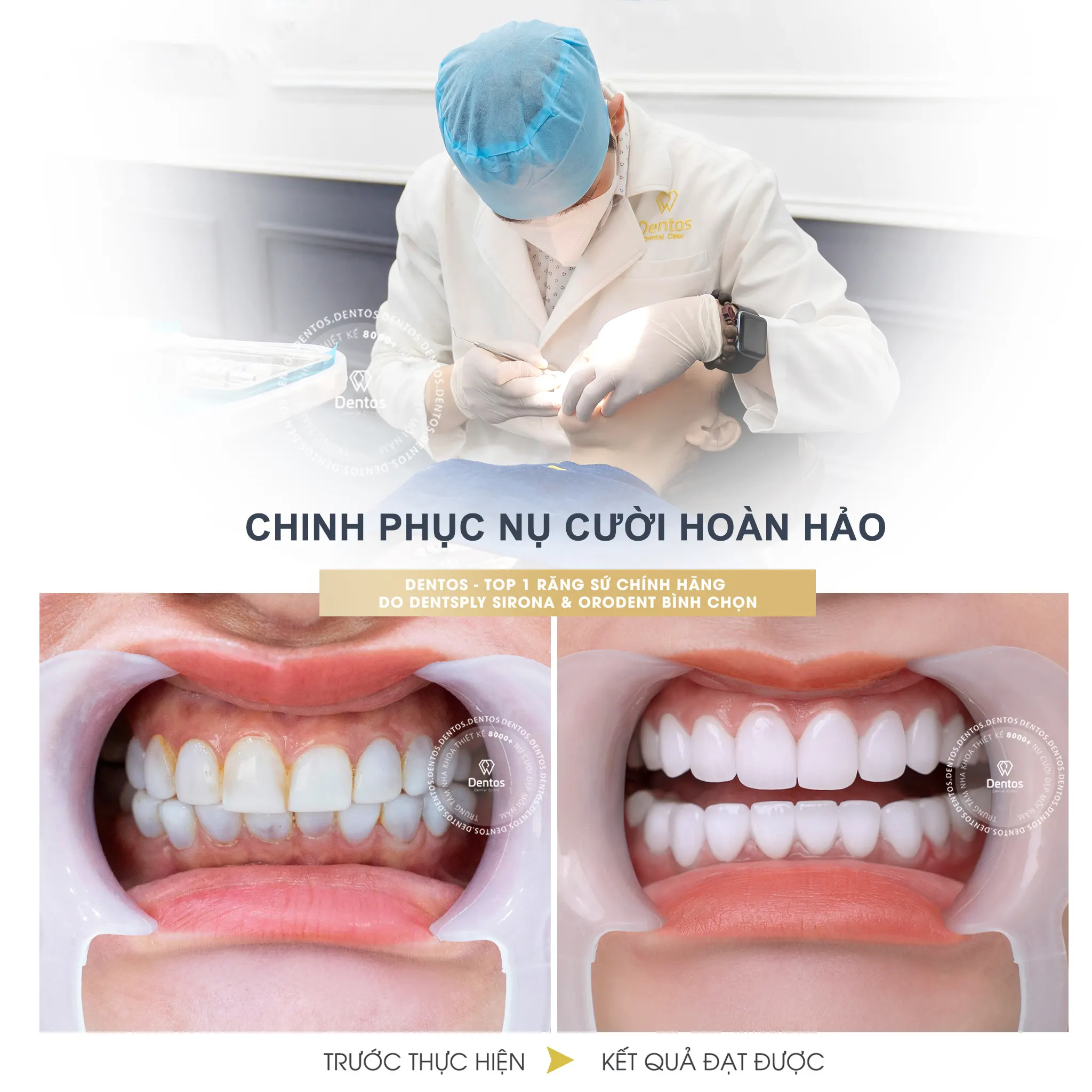 Nha khoa Dentos tự hào là TOP 1 Nha khoa có sản lượng tiêu thụ răng sứ chính hãng